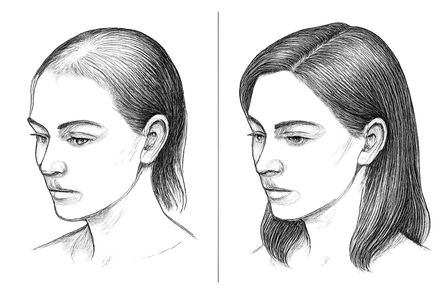 greffe de cheveux femme témoignage