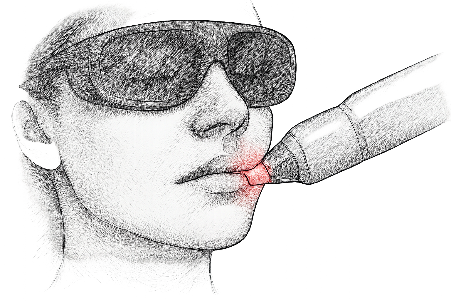 épilation laser moustache femme avis